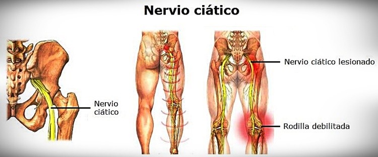 Pilates y ciática · Pure Pilates