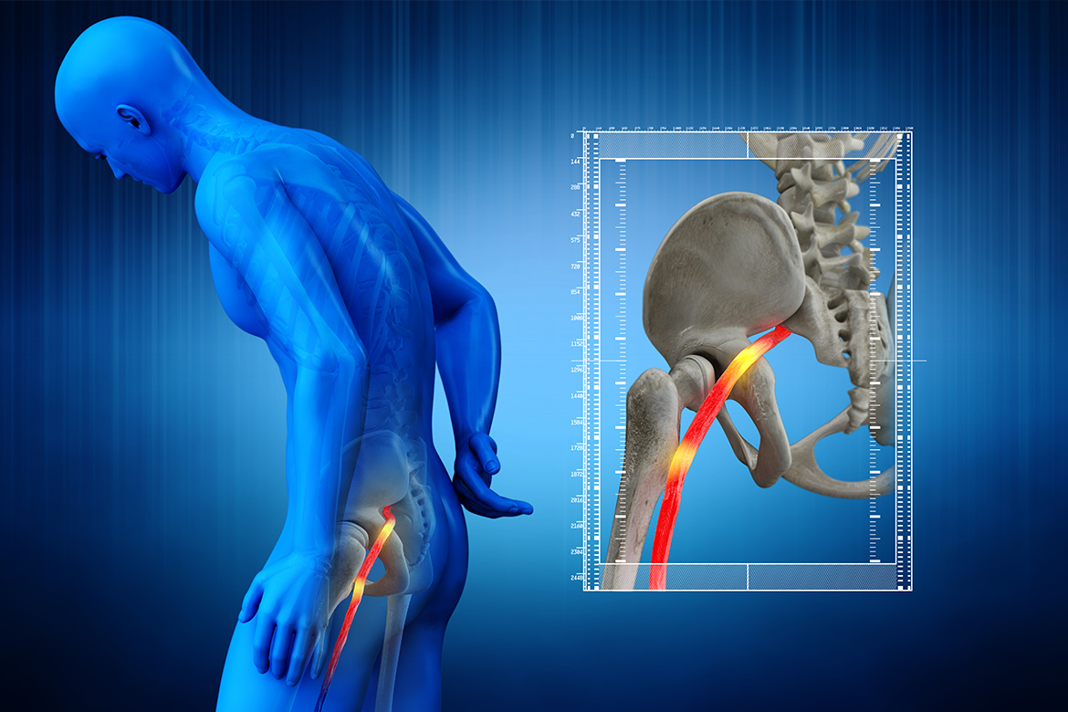 Pilates y ciática